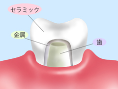 ゴールドインレー