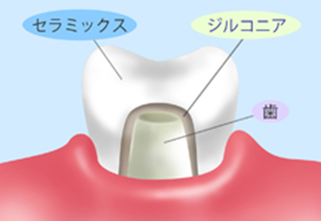 ジルコニアセラミックスクラウン