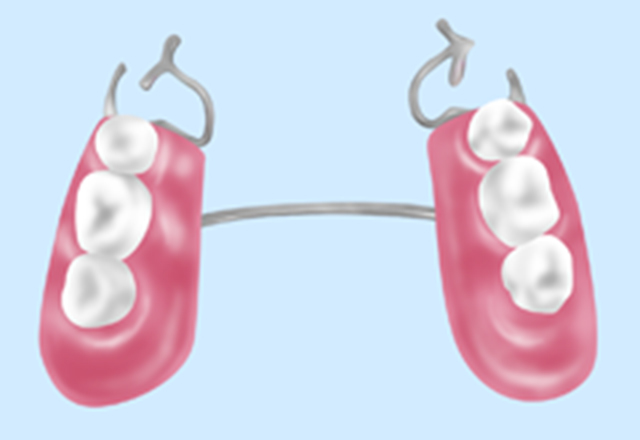 部分入れ歯を使う方