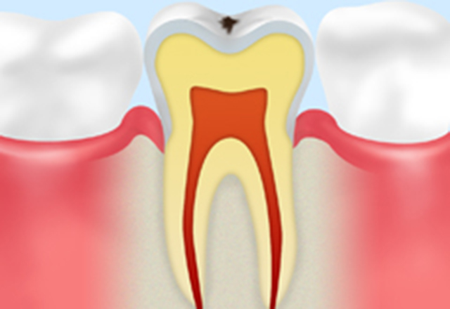 ごく初期の虫歯