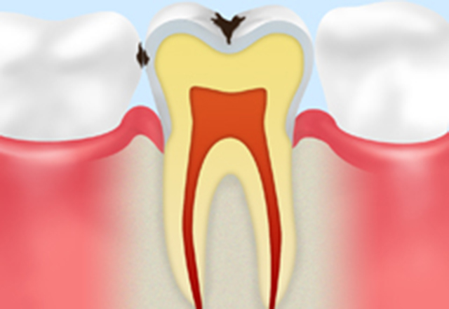 エナメル質の虫歯
