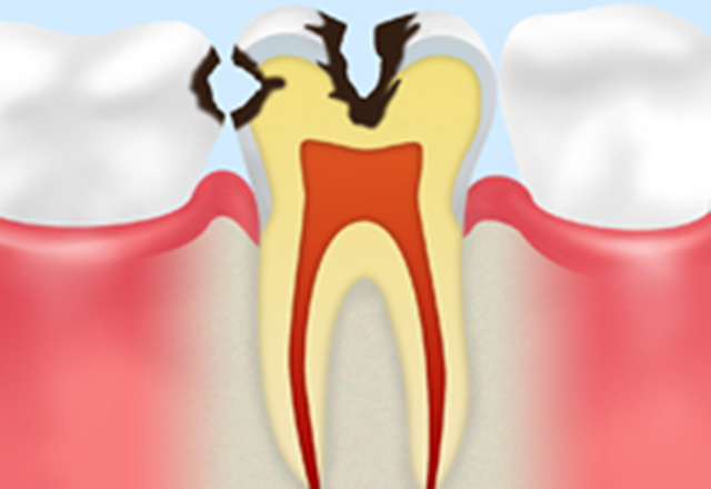 象牙質の虫歯