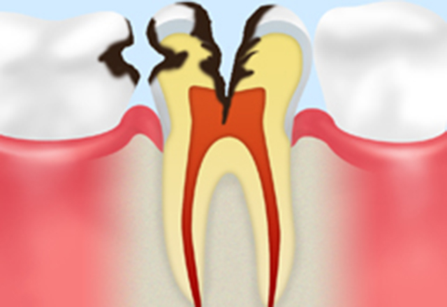 歯髄の虫歯